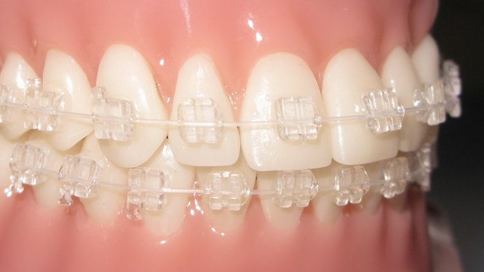 phương pháp chỉnh nha